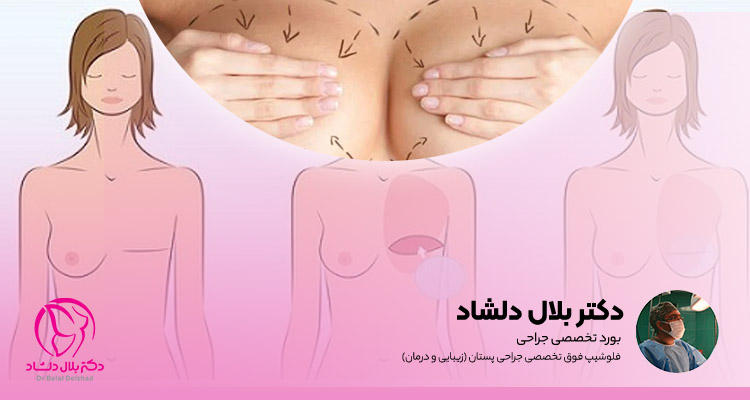 عمل ماموپلاستی و سرطان سینه